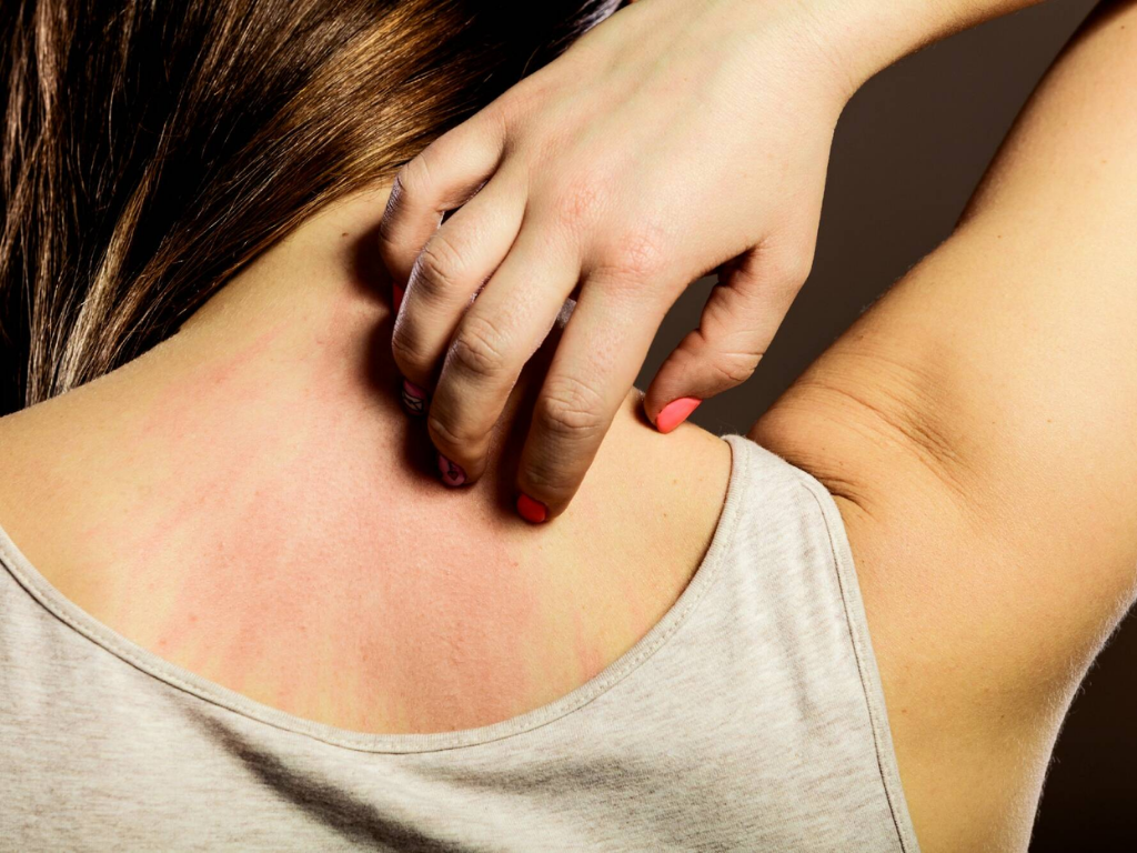 Why Am I Allergic To Weave? Common Reactions And Safe Treatments 1 You can suddenly become allergic to a weave