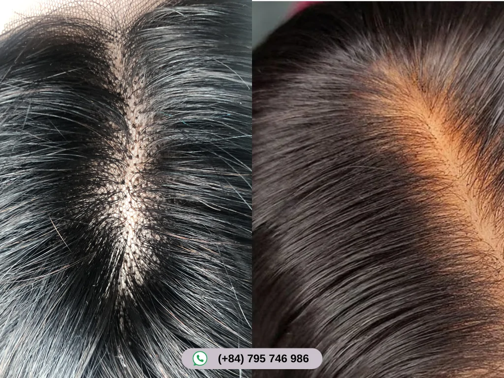 Bleaching knots lightens wig knots for a natural scalp look